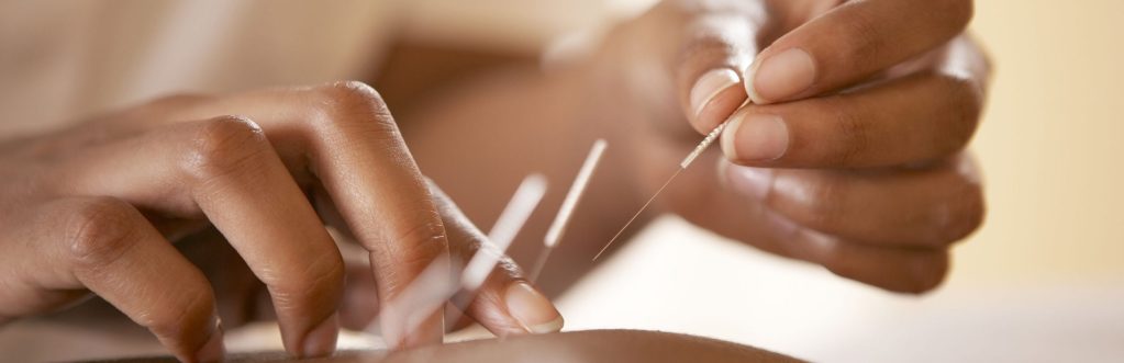Acupuncture Formby